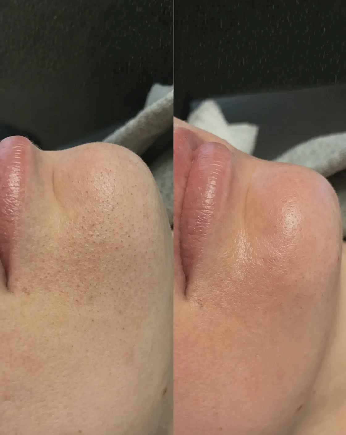 Comparação de pele antes e depois de um protocolo de limpeza